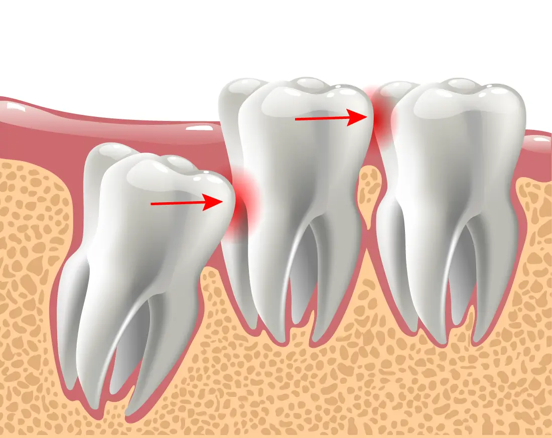Wisdom Teeth Removal