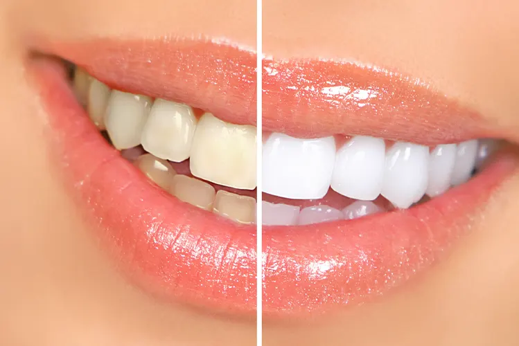 Teeth Whitening In Franklin, MA