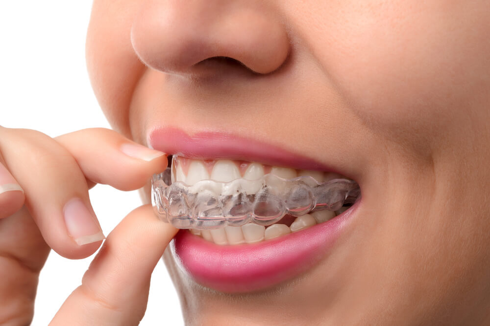 What To Expect On Your First Day With Invisalign