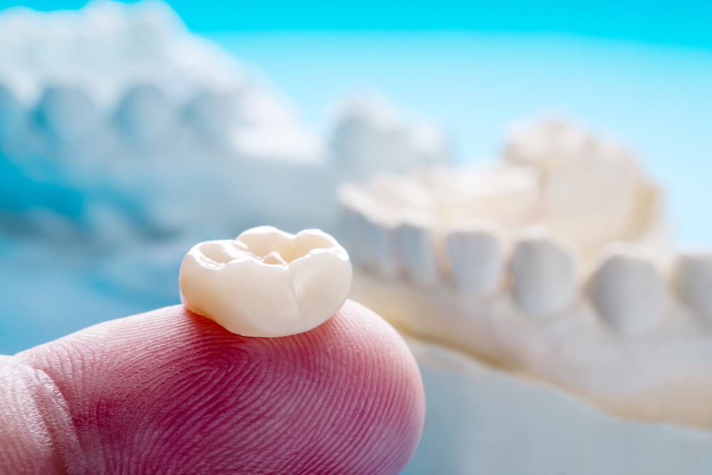 Can You Get a Dental Crown in One Day?