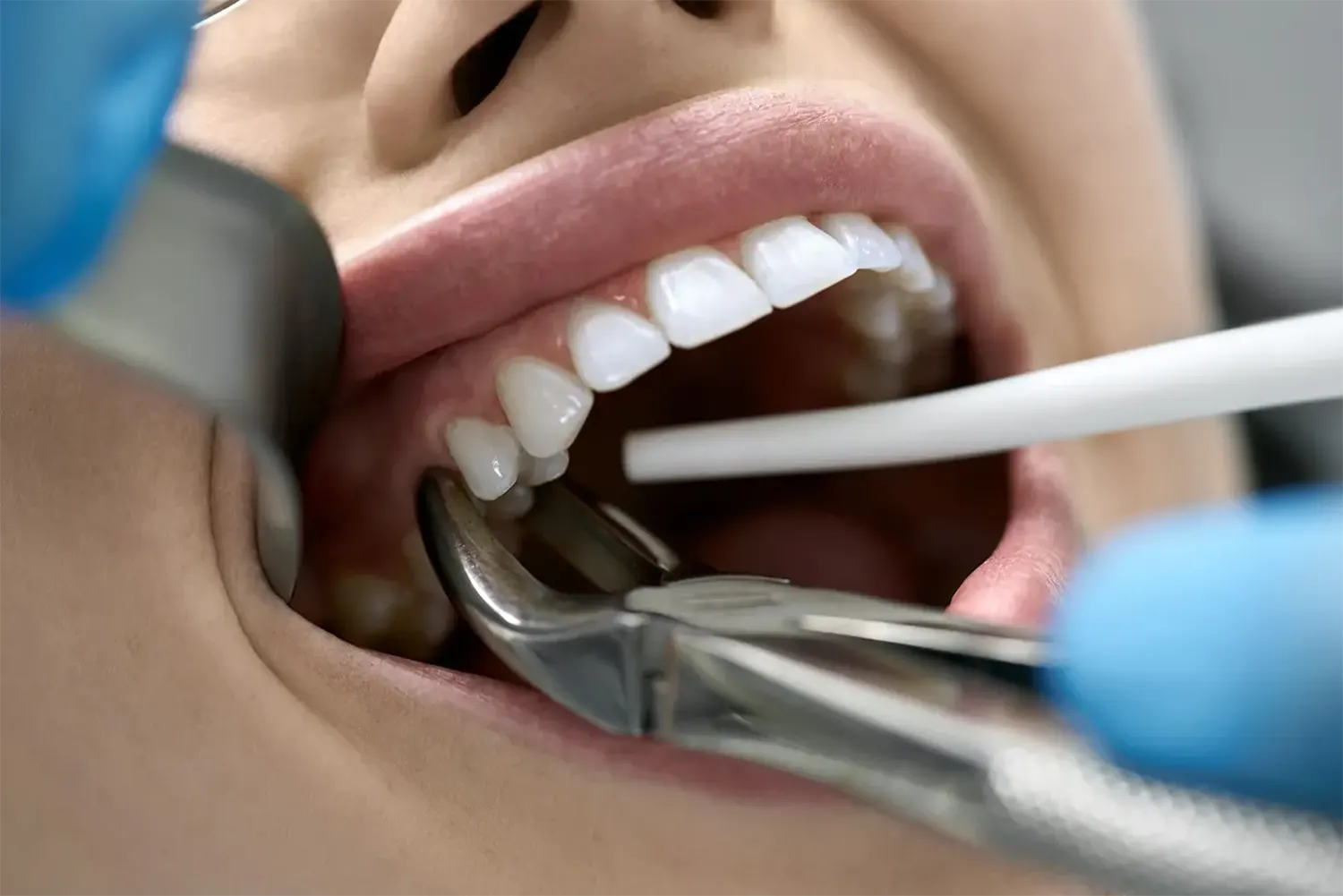 How Long After Tooth Extraction Can I Eat?