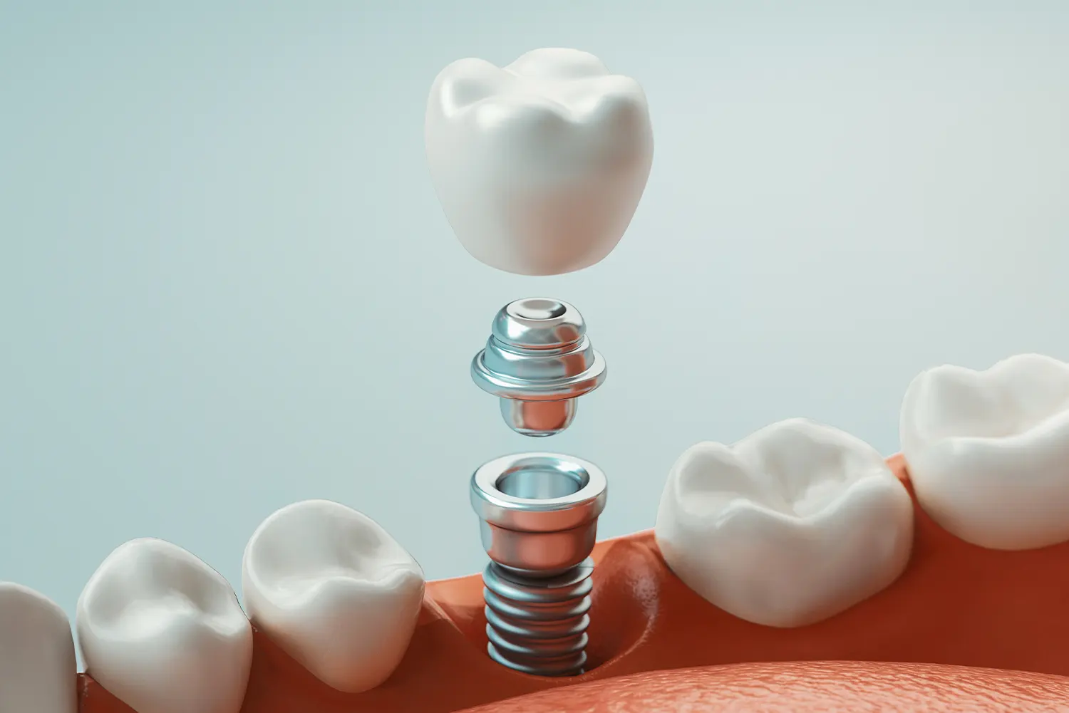 Dental Implant Timeline: What to Expect